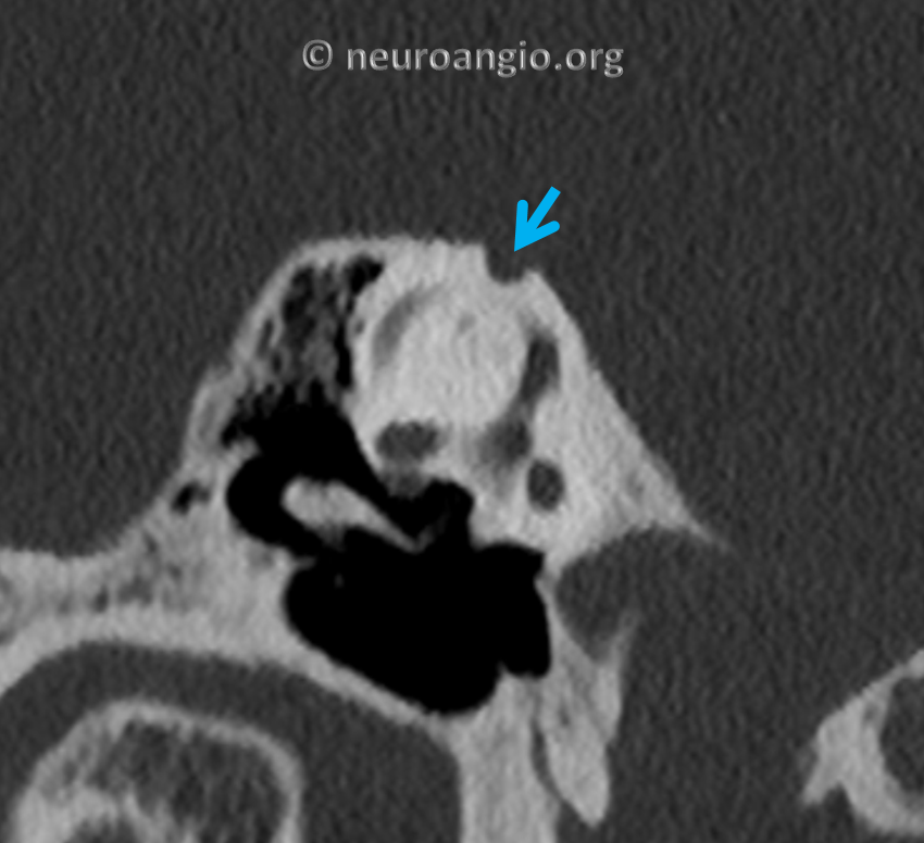 Pulsatile Tinnitus Superior Semicircular Canal Dehiscence